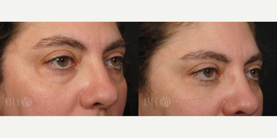Eyelid Surgery before and after photo