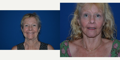 Facelift before and after photo