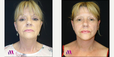 Facelift before and after photo