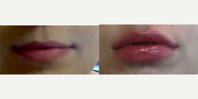 Juvederm before and after photo