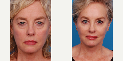 Lower Facelift before and after photo