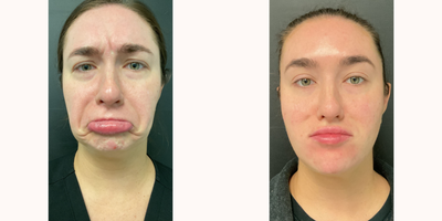 Botox before and after photo