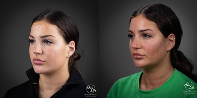 Buccal Fat Removal before and after photo