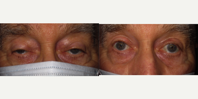 Double Eyelid Surgery before and after photo