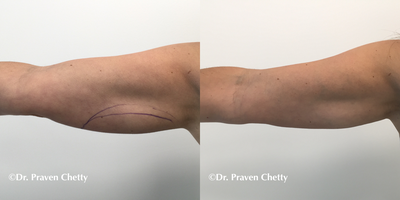 Exilis before and after photo