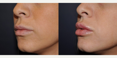 Lip Fillers before and after photo