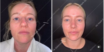Rhinoplasty before and after photo