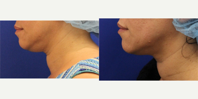 Ultherapy before and after photo