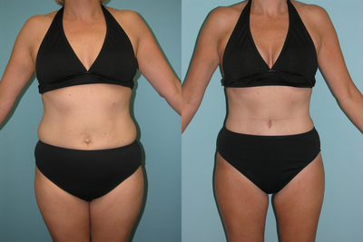 Tummy Tuck before and after photo