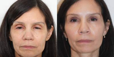 Ptosis Surgery before and after photo