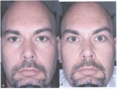 Restylane before and after photo
