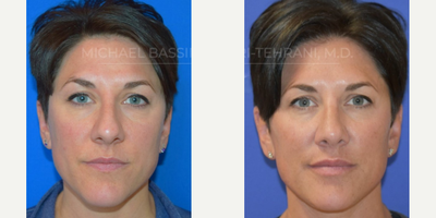 Rhinoplasty before and after photo