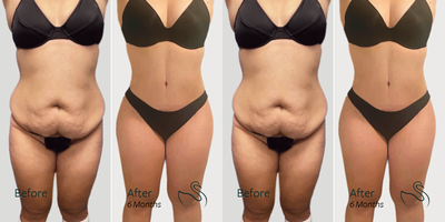Smart Lipo before and after photo