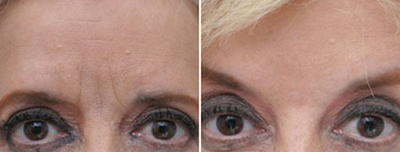 Botox before and after photo