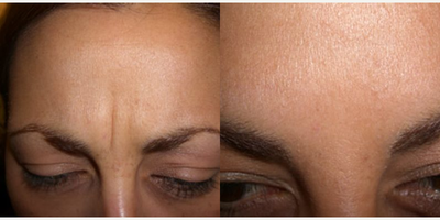 Botox before and after photo