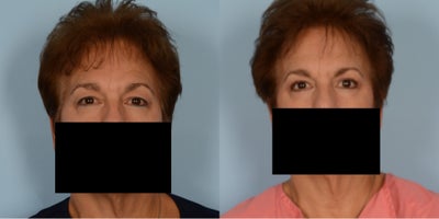 Eyelid Surgery before and after photo