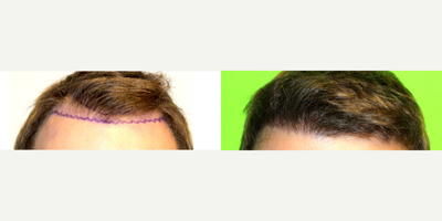 Hair Transplant before and after photo