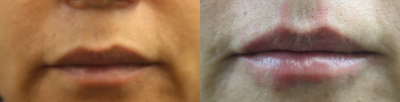 Lip Fillers before and after photo