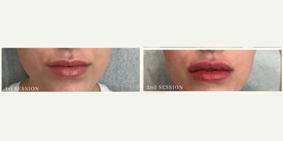 Lip Fillers before and after photo