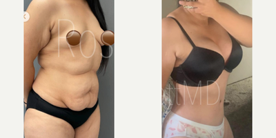 Lipo 360 before and after photo