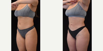 Liposuction before and after photo