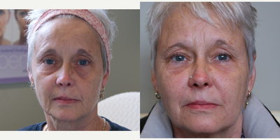Sculptra before and after photo