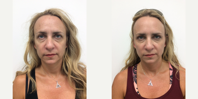 Dermal Fillers before and after photo