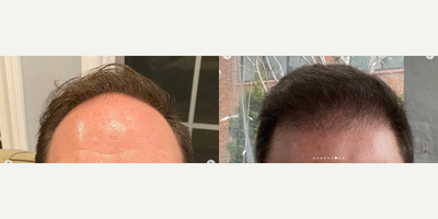 Hair Transplant before and after photo