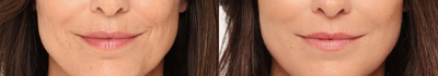 Radiesse before and after photo