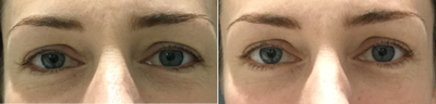 Ultherapy before and after photo