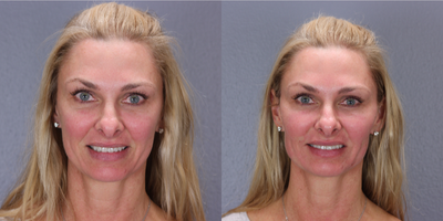 Bellafill before and after photo