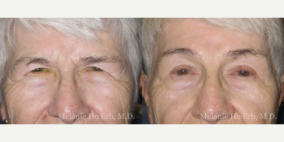 Brow Lift before and after photo