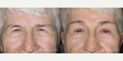 Brow Lift before and after photo
