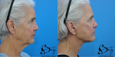 before and after image
