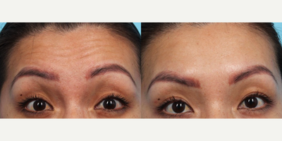 Dysport before and after photo