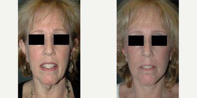 Facelift before and after photo