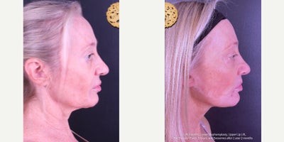 Facelift before and after photo
