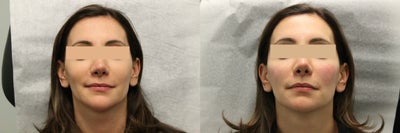 Voluma before and after photo