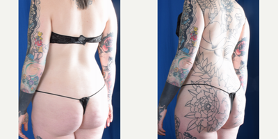 Brazilian Butt Lift before and after photo