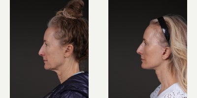 Brow Lift before and after photo