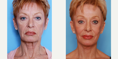 CO2 Laser before and after photo