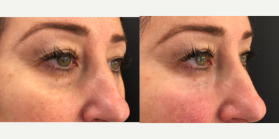 Dermal Fillers before and after photo