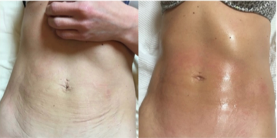 Exilis before and after photo
