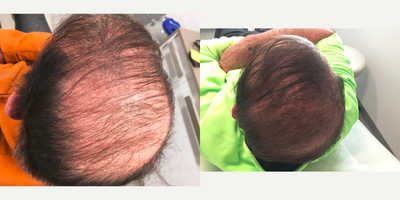 PRP for Hair Loss before and after photo