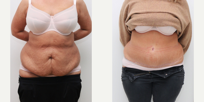Drainless Tummy Tuck before and after photo