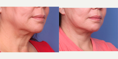 Facelift before and after photo