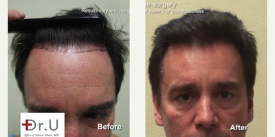 FUE Hair Transplant before and after photo