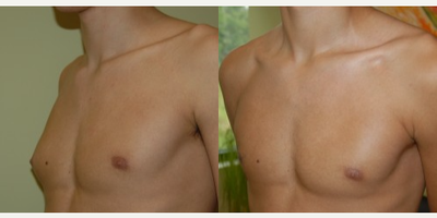Gynecomastia Surgery before and after photo