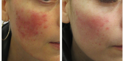 Laser Resurfacing before and after photo