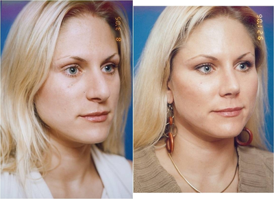 Septoplasty before and after photo